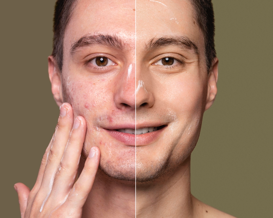 SKIN PURGE.